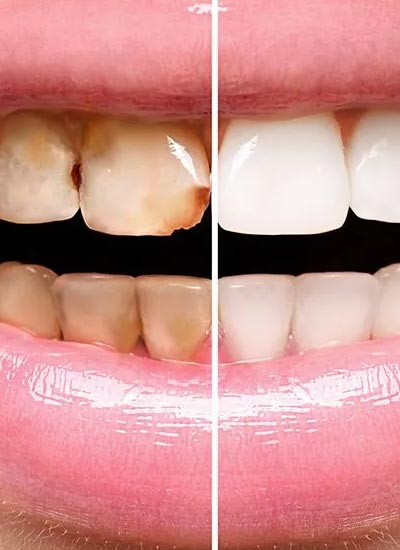 Cosmetic-Dentistry in Bhimavaram