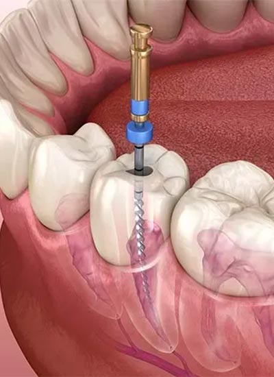 Endodontics in Kukatpally