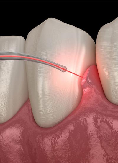 Laser-Dentistry in Mancherial