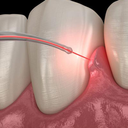 Laser Dentistry