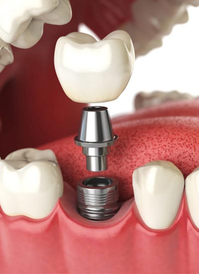 Dental Implants in Kukatpally